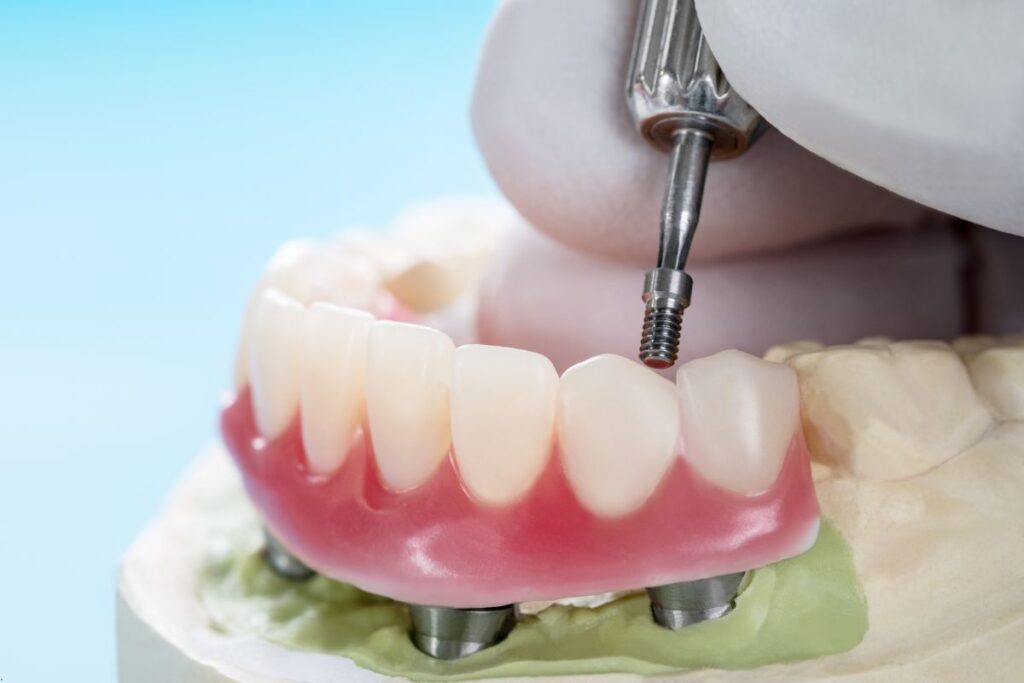 dental implants Hoover