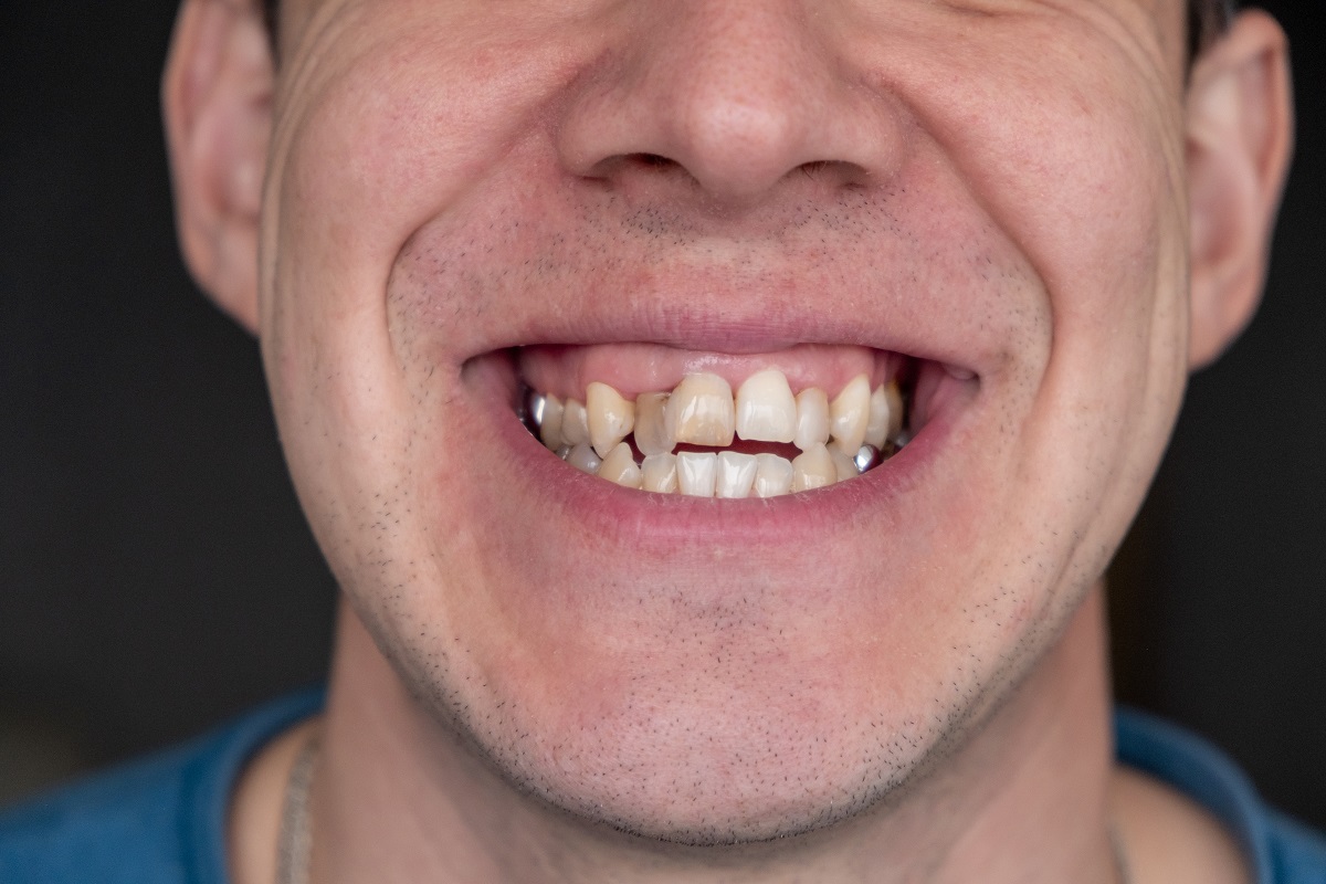 Why Are My Teeth Shifting as an Adult? A Guide for Hoover, AL Patients