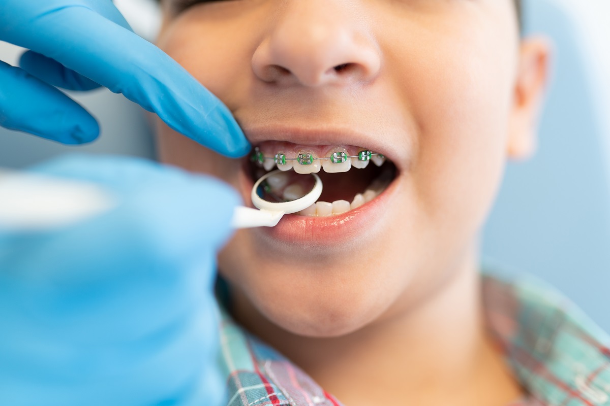 Teeth Shifting After Braces? What It Means and When to Worry